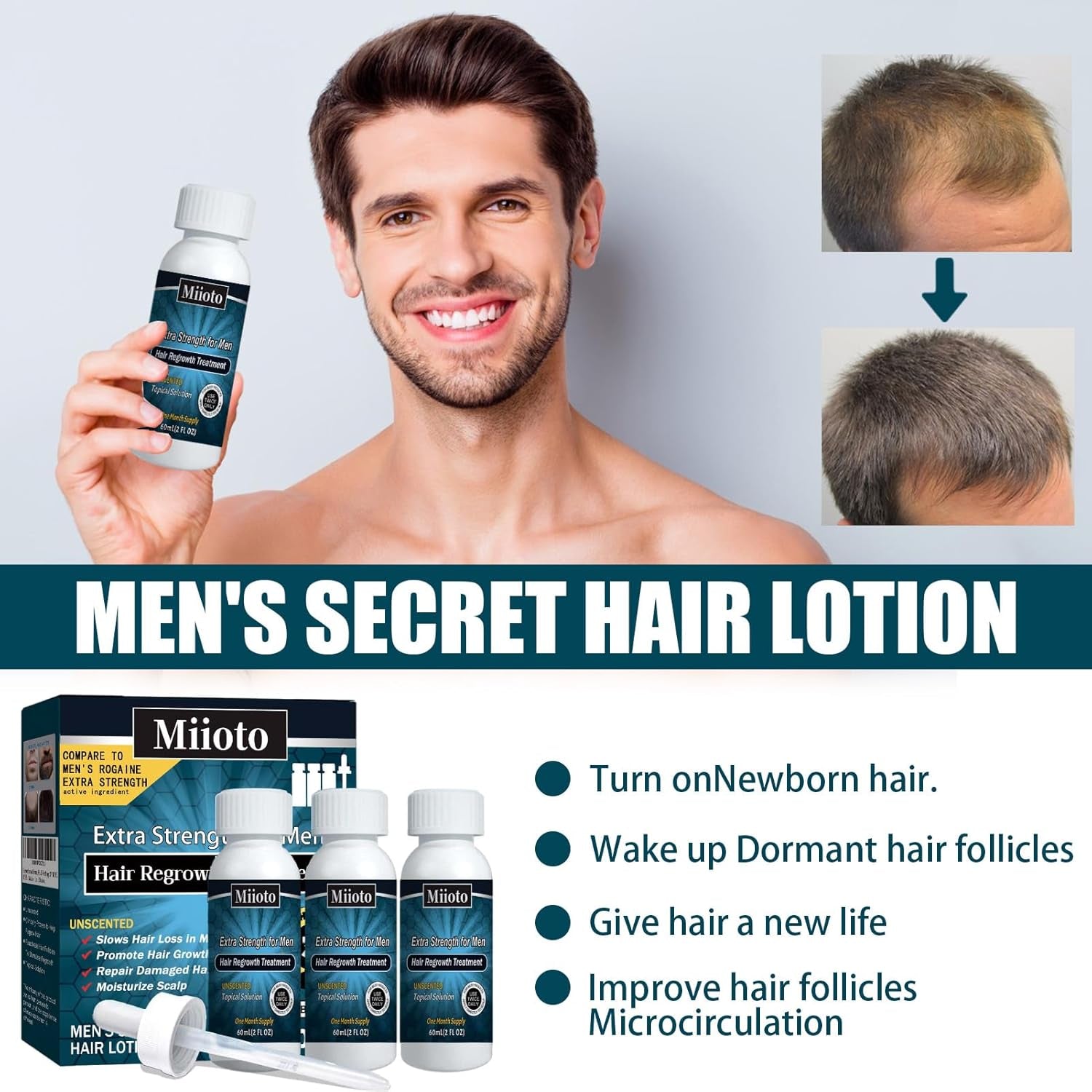 Miioto ser de creștere a părului, produs de creștere a părului pentru bărbați, ser de păr pentru creșterea părului, îngrijirea scalpului promovează părul mai gros hrănește scalpul și previne căderea părului, 3 * 60 ML Ingrijirea parului Naty Shop